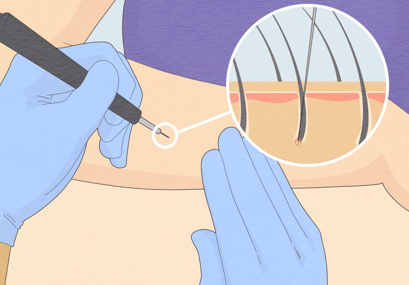 How to Make Arm Hair Thinner: 9 Steps