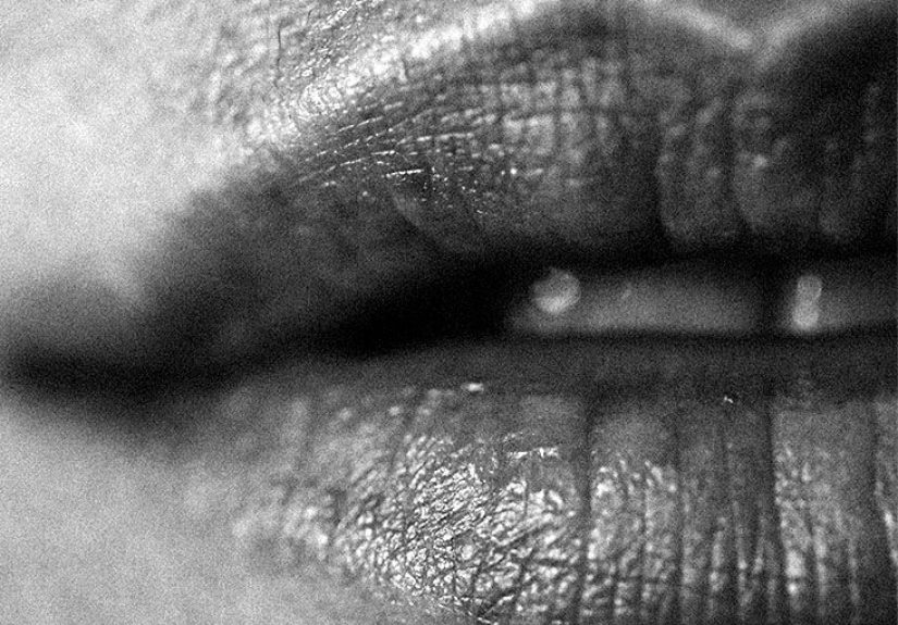 Lip flip: What it is, results, side effects, and more