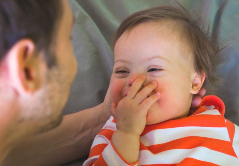 Mosaic Down Syndrome: Symptoms and Diagnosis