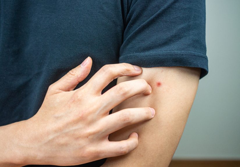 No-See-Um Bites vs. Bed Bug Bites: 6 Ways to ID Biting Bugs