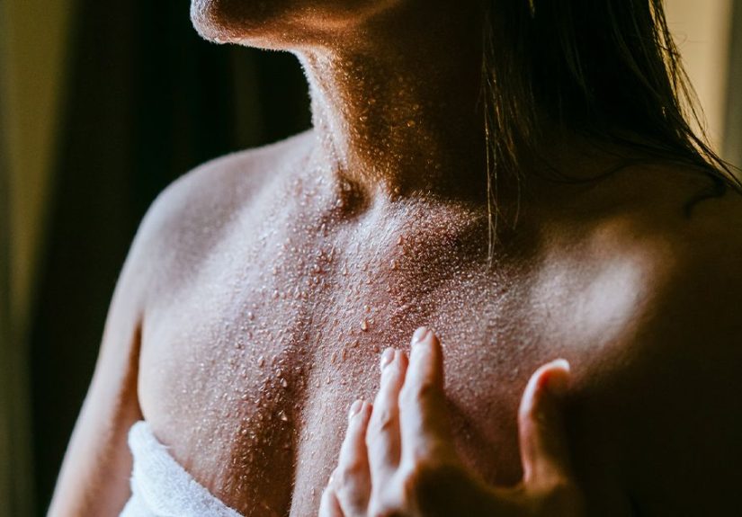 Prickly Heat Rash: Causes, Symptoms, Treatments