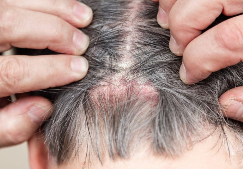 Scalp Psoriasis vs. Dandruff: What’s the Difference?