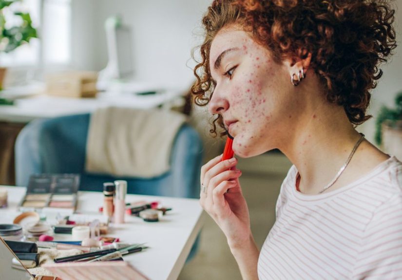 Acne Mechanica: Causes, Treatment, and Prevention