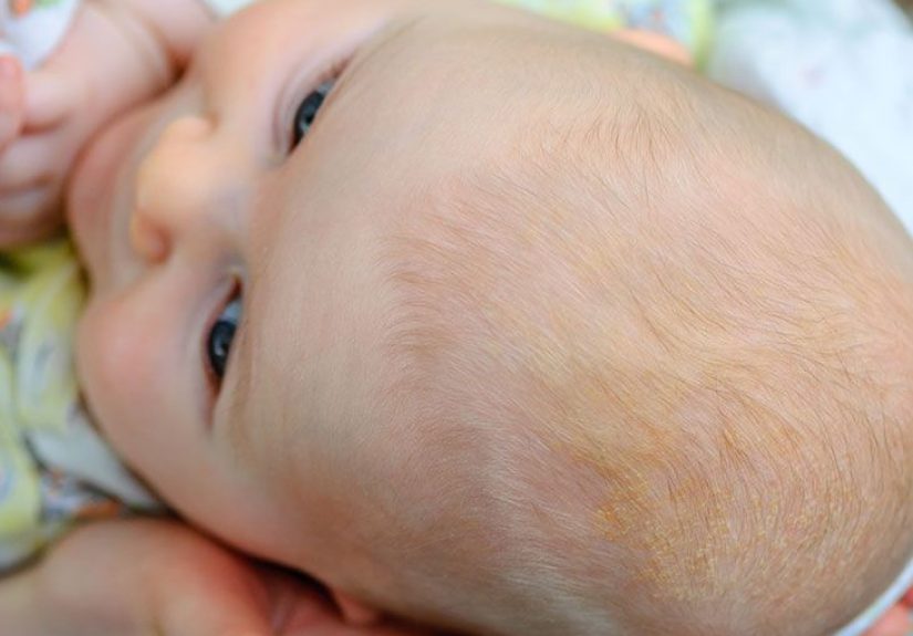 Baby's dry scalp: Treatments and causes