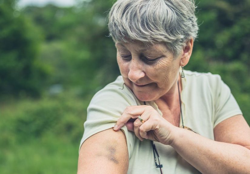 Bruise That Won’t Go Away: Causes, Concerns, Treatment & More
