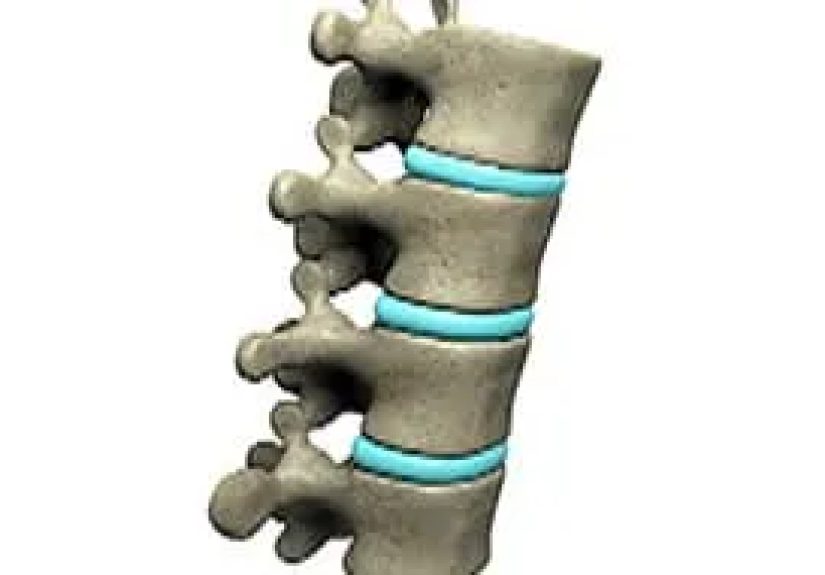 Critical Meaning of Vertebra Fracture - Watch WebMD Video