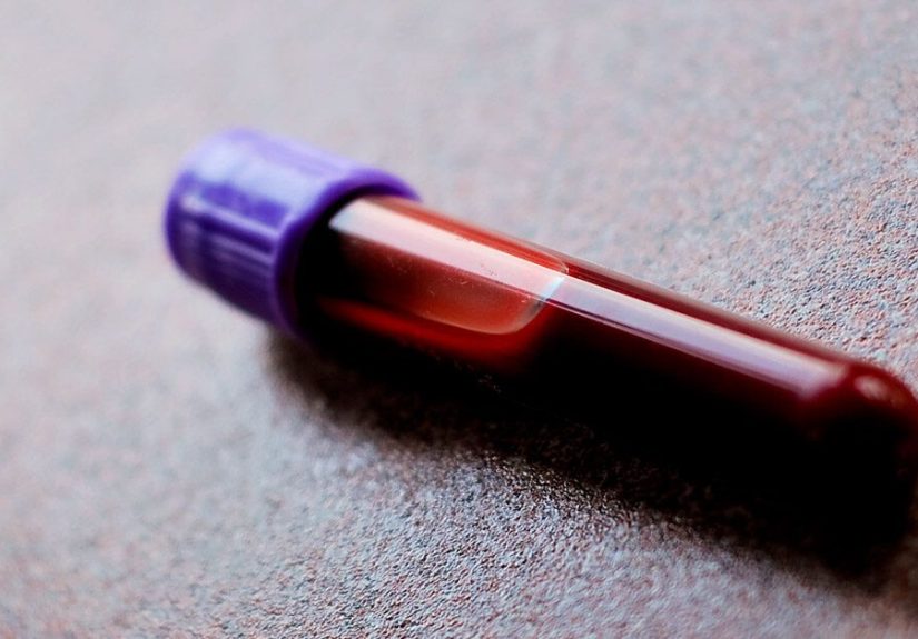 GAD Antibodies and Diabetes: What You Should Know