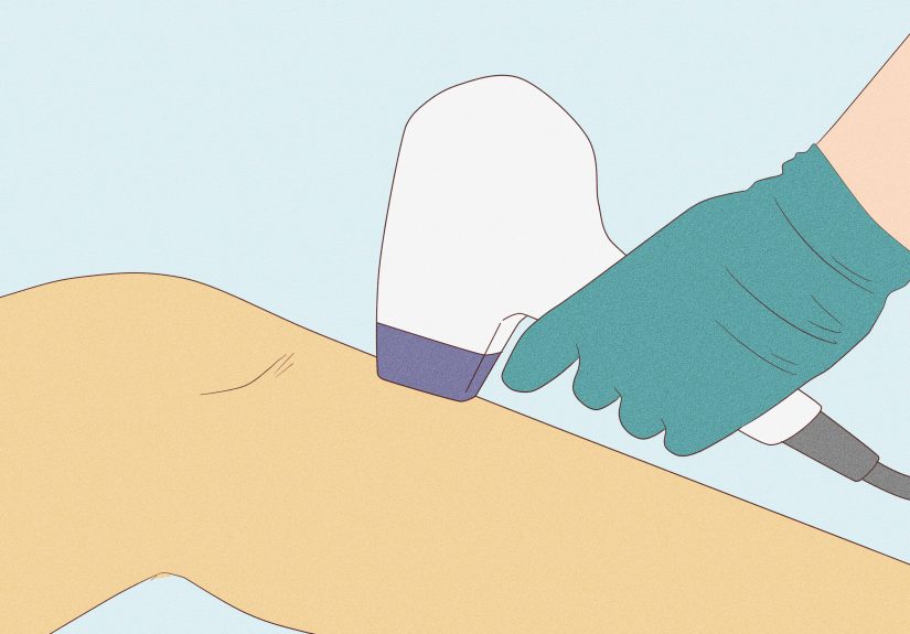 How to Prevent Ingrown Hairs on Your Legs