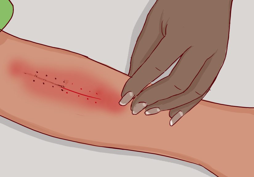 How to Remove Surgical Staples: 8 Steps