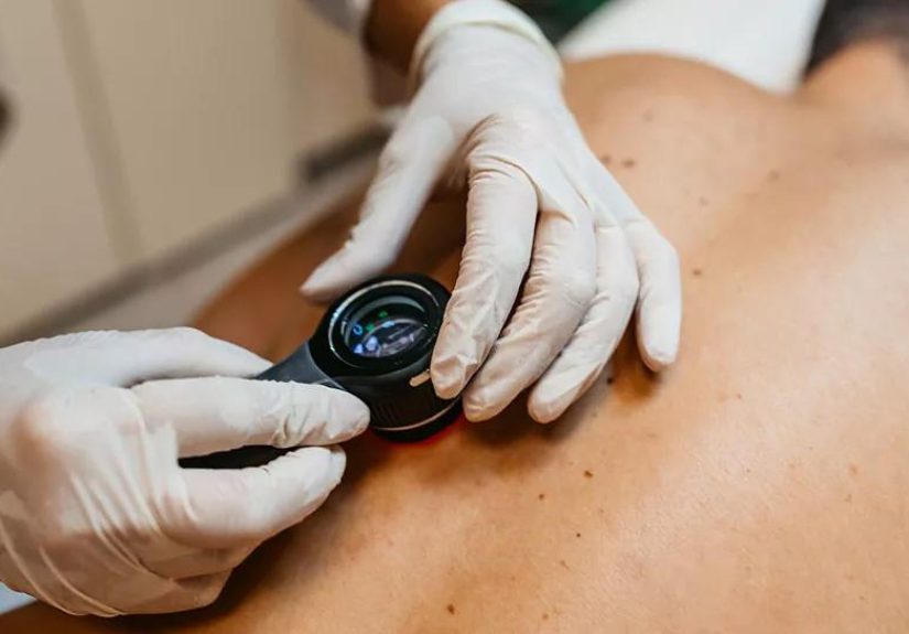 How To Tell if a Mole Is Cancerous: 8 Signs