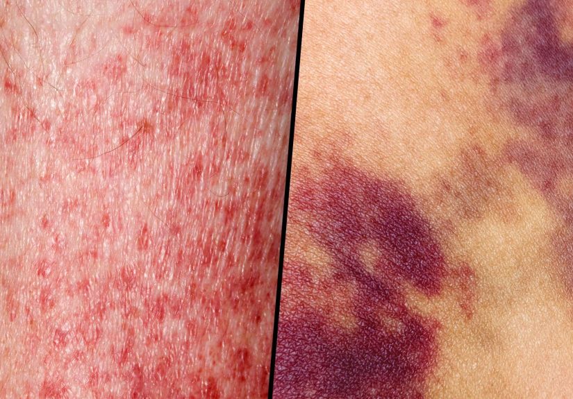 Leukemia Symptoms and Signs