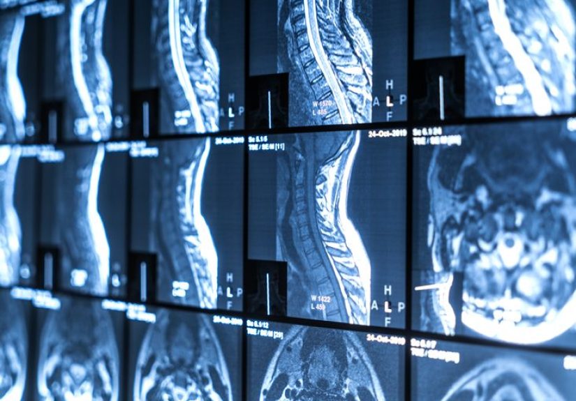 Osteochondroses: Types, symptoms, treatment, and outlook