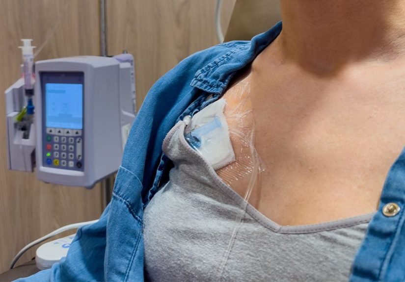 Port Placement and Starting Chemo