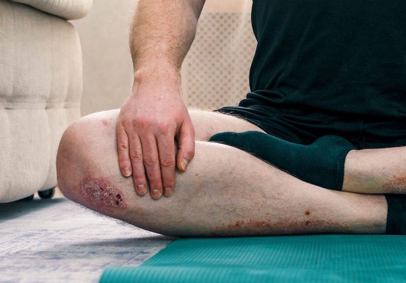 Psoriasis and Liver Disease: What's the Link?