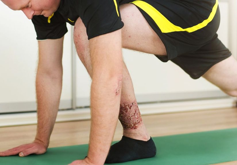 Stem Cells for Psoriasis: Research Summary and Update