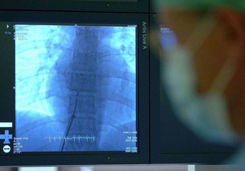 Atrial Septal Defect: Definition, Causes, Treatment, Outlook