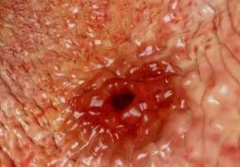 Bleeding ulcer: What causes it and is it serious?
