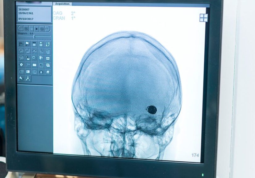 Life After a Brain Aneurysm: Long-Term Effects and Recovery
