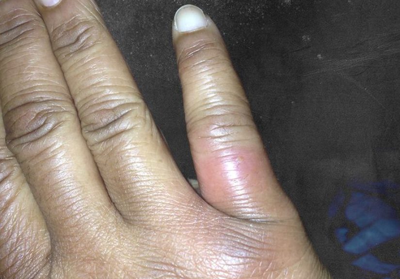 Spider bites: Identification and treatment