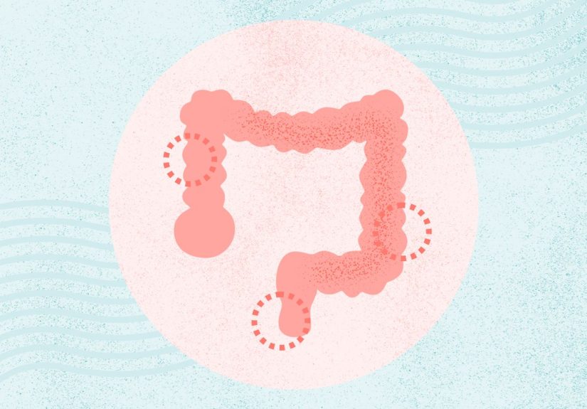 Crohn’s Colitis (Granulomatous Colitis)