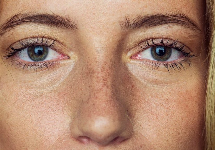 Eyelash Transplant Surgery: Pros, Cons, and Cost