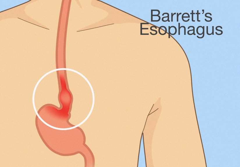 How to Heal Damage from Acid Reflux: 13 Proven At-Home Remedies