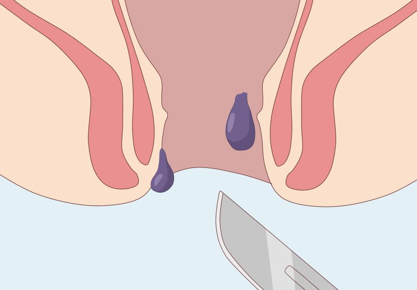 How to Treat Pregnancy Hemorrhoids with Home Remedies